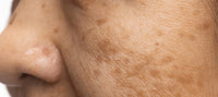 Helps prevent acne marks and sun damage